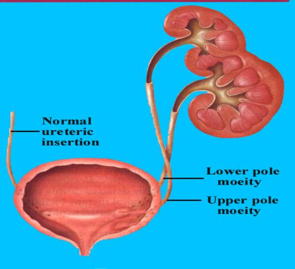 Laparoscopic  Hemi Nephrectomy